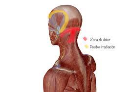 Son las encargadas de aguantar el peso de la cabeza y proporcionar movilidad a la cabeza y, sobretodo, al cuello. Dolor De Cabeza De Origen Cervical Prolive