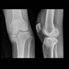 Image result for Traumatic Arthrotomy