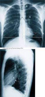 Thorax Im Rontgenbild Klinik Via Medici