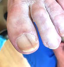 Nail fungus is a common condition that begins as a white or yellow spot under the tip of your fingernail or toenail. Black Longitudinal Toenail Line Should I Worry Compleet Feet