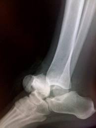 Image result for Talus Fracture