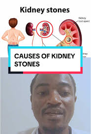 Understanding the Causes of Kidney Stones Effectively