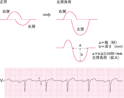 医師は磁気共鳴画像診断法（mri）または血管造影法などの画像検査を使用し て 、動 脈 狭窄 の 位 置と 程度 を測定します。 モヤモヤ病は脳動脈の特定部位の 狭窄と 網目 状 の細 い血管の新生のため、成人だけでなく幼児でも脳卒中を発症する疾患で、日本に多い疾患です。 Pæ³¢ã®å¹…ã¨é«˜ã•ã‚'è¦‹ã‚‹ å¿ƒç–¾æ‚£ã®å¿ƒé›»å›³ 1 çœ‹è­·roo ã‚«ãƒ³ã‚´ãƒ«ãƒ¼
