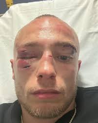 Left eye went in the 2nd from a sharp jab. Was seeing double the majority  of the fight. Enjoyed every moment of the event grateful to be a part of it  all. @