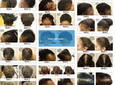 Ta was first reported in 1907 in greenlandic . Which Hairstyles Are Best If You Have Traction Alopecia