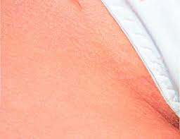 Laser devices emit high energy beams that target a specific color (chromophore); Bikini Line Brazilian Laser Hair Removal At Sk N Clinics