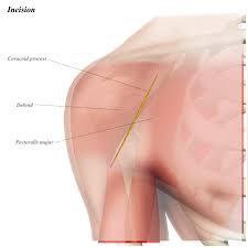 Tutorials on the shoulder muscles (e.g rotator cuff muscles: Shoulder Anterior Deltopectoral Approach Approaches Orthobullets