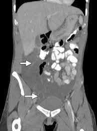 It shows a predilection for the surfaces of the pelvic viscera and has a high rate of recurrence after excision. Case 146 Benign Multicystic Mesothelioma Radiology
