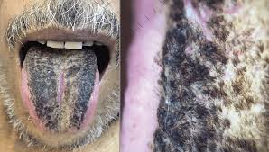Image result for black hairy tongue symptoms