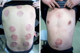 Image result for koebner phenomenon psoriasis