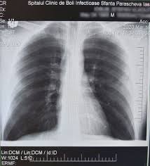 Cu toate acestea, tratamentul prompt reduce semnificativ riscul de deces. Cum AratÄ PlÄmanii Bolnavilor De Covid 19 DiferenÅ£a La Radiografiile Unui TanÄr Èi A Unui BÄtran Sunt Clare Ziarul Romanesc Austria