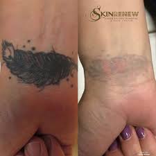 Before and after laser tattoo removal treatment. Before And After Laser Tattoo Removal Photos