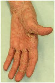Image result for scabies norvegica