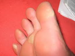 Sometimes these blemishes are red. Yellow Feet 6 Potential Causes