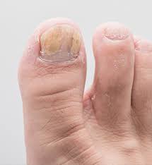 Image result for Pitting nails feet