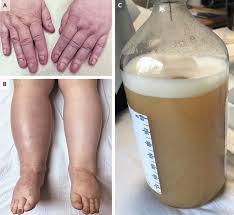 Image result for Yellow nail syndrome feet