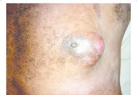 Male breast cancer represents less than 1 percent of all breast cancer diagnoses. Case Of Male Breast Cancer Diagnosed At Lautoka Hospital Fiji Download Scientific Diagram
