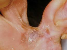 Pain in the affected bone is the most common sign of bone cancer. Acral Lentiginous Melanoma Dermnet Nz