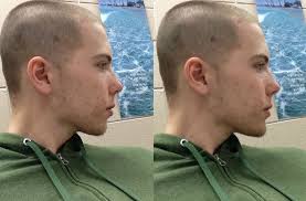 Surgical correction for weak chin desired