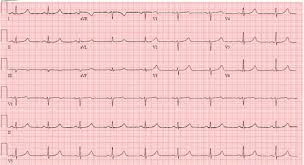 Tests your doctor may recommend include: Cardiac Arrest Following Exercise A Prototypical Presentation Of Lqt1 American College Of Cardiology