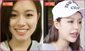 She Was Already Pretty But Youtube Star Had Plastic Surgery Over 30 Plastic Surgery Before And Celebrity Plastic Surgery Plastic Surgery Celebrity Teeth