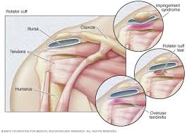 Illustration Of Three Types Of Rotator Cuff Injuries Rotator Cuff Injury Rotator Cuff Rotator Cuff Tear