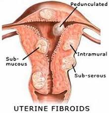 Fibroid tumors are benign by definition. 120 Fibroids Tumors Ideas Fibroids Uterine Fibroids Fibroid Tumors