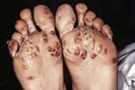 Image result for Poststreptococcal Reactive Arthritis