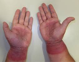 Image result for dermatitis contacta