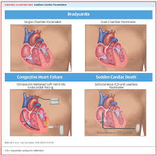 Icd vs pacemaker statistically, the number one killer is heart disease. Permanent Leadless Cardiac Pacing American College Of Cardiology