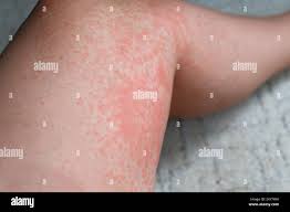 Image result for Photodermatitis