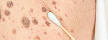 Skin cancer is one of the most common types of cancer. Vancouver Laser Mole Removal Surgical Removal In Surrey Medical Laser And Skincare Clinic