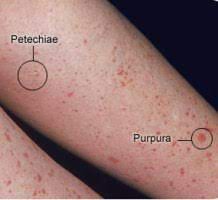 Purpura is not a disease per se but is indicative of an underlying cause of bleeding. Purpura Physiopedia