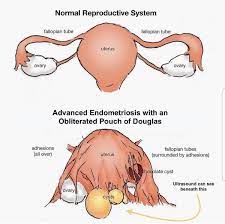 Stages 1 and 2 are peritoneal. Unfreezing The Frozen Pelvis Indian Center For Endometriosis Ice
