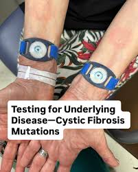 Image result for Sweat Chloride