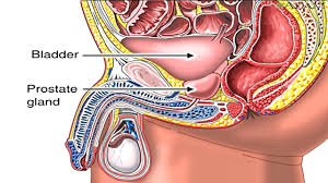 This study sought to evaluate ovs and ur requiring catheterization following sbrt for prostate cancer. Enlarged Prostate Gland Benign Prostatic Hyperplasia Animation Symptoms And Treatment Of Bph Video