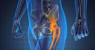 What You Need To About Osteoarthritis Of The Hip Hip Arthritis Exercises Arthritis Exercises Hip Arthritis