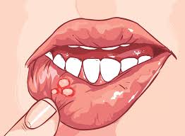 Canker sores can be found anywhere in the mouth from the cheek, inner lip, on and under the tongue, and even in the throat. What Is An Aphthous Ulcer Canker Sore And How Are They Treated Bmg Pharma