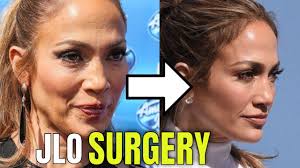 Jennifer is a pioneer of embracing the big bum long before kim kardashian and nicki minaj even if she denies it, several plastic surgeons say that j lo's face shows some subtle signs of rhinoplasty. Jennifer Lopez Plastic Surgery 2020 Youtube