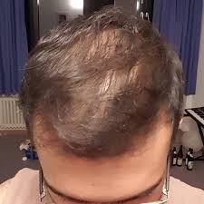 This page should not be taken as medical advice. Will I Maintain This Hair On Minoxidil And Dutasteride After Restarting Photos