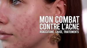 La jeune lyonnaise explique souffrir d'acné hormonale depuis plus de 5 ans. Mon Combat Contre L Acne Cause Traitements Mon Avis Sur Roaccutane Youtube
