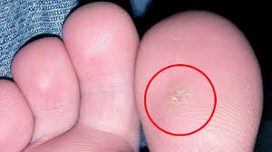 Warts Skin Problems Nashville Podiatrists The Nashville Foot And Ankle Group