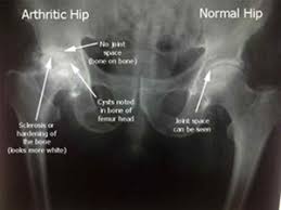 Maybe you would like to learn more about one of these? Hip Arthritis Info And Help Arthritisremedieship Hip Arthritis Rheumatoid Arthritis Treatment Arthritis Remedies