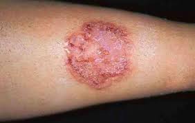Ringworm Body Symptoms Causes Treatment And Diagnosis Findatopdoc Ringworm infections are observed on the skin, scalp and nails. ringworm body symptoms causes