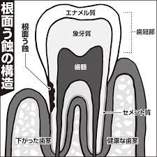 大人の虫歯ケア 歯茎が下がる 根面う蝕 を予防する歯の最新ケア方法 50代以上は要注意 1 1 介護ポストセブン 歯茎が下がる 虫歯 50代