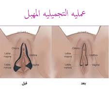 عملية تجميل المهبل بالصور قبل وبعد
