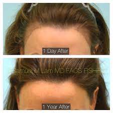 This 44-year-old Female Is Shown One Day And One Year After A Female Hairline Lowering Hair Hairline Transplant Hair Transplant Procedure Hair Transplant Women