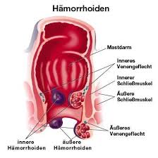 Stuhl entsteht bei verdauungsvorgängen im darm und besteht zu einem hohen anteil aus wasser. Riss Im Darm Hilfe Blut Stuhlgang