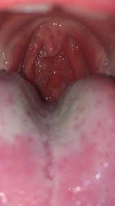 Check spelling or type a new query. Is It Normal To Get Red Bumps On My Throat When I Have A Sore Throat Medical