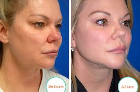 Life-Changing Plastic Surgery Stories} “I Felt Like My Lower Face Was  Sinking Into My Chest.”